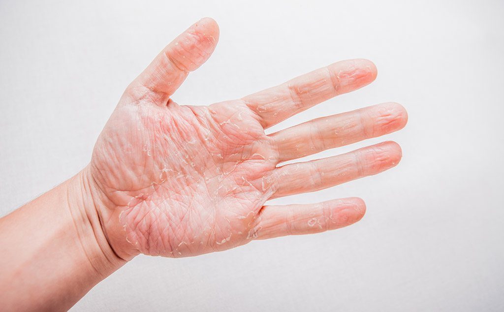 what-is-eczema-and-how-do-you-treat-it