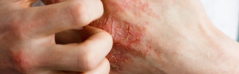 Eczema And Atopic Dermatitis Vs Psoriasis: What’s The Difference?