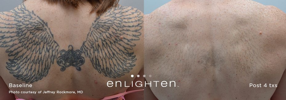 Laser Tattoo Removal – Image Enhancement Center