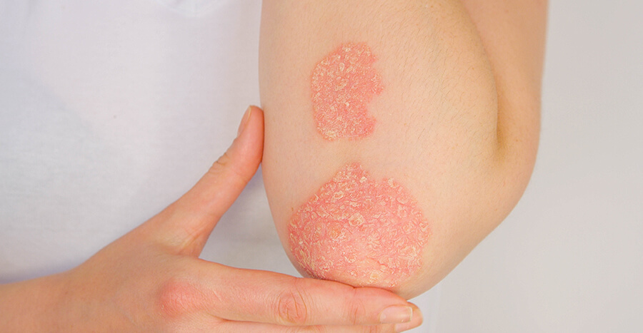 Psoriasis symptoms and treatment Lafayette, LA