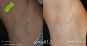 Laser Hair removal Lafayette LA for All Skin Types Dermatology