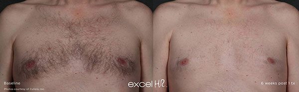 Full Chest - Laser Hair Removal for Women – Hyaface