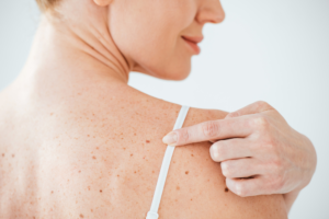 mole removal