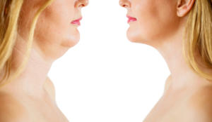 double chin treatment